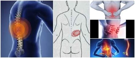 Dolor De Espalda Media Signos S Ntomas Factores De Riesgo Causas