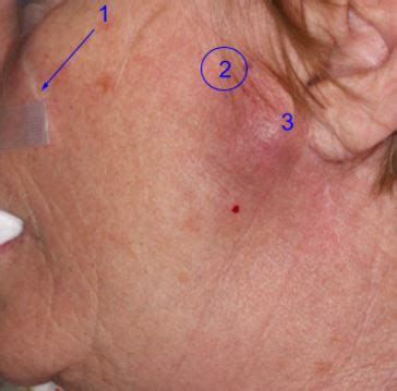 Adnexal Squamous Cell Carcinoma Recurring In Parotid Skin Cancer And