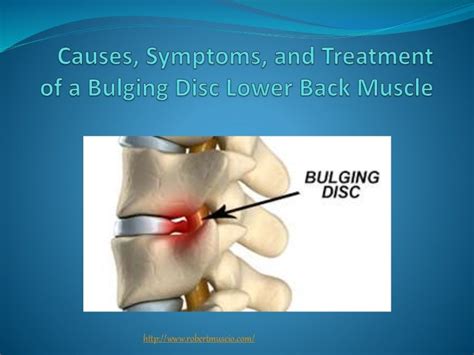 Causes Symptoms And Treatment Of A Bulging Disc Lower Back Muscle