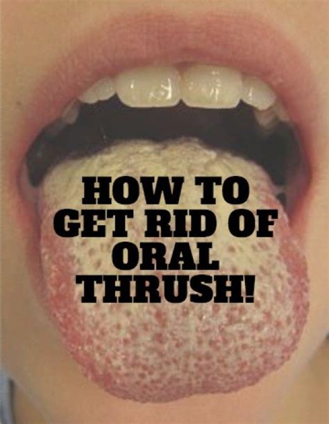 9 Methods For How To Battle Oral Thrush Oral Thrush Remedies Home