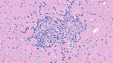 Heart Pathology