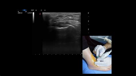 Ultrasound Guided Ankle Tibiotalar Joint Joint Injection Youtube