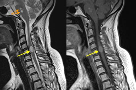 Spinal Cord And Vertebral Column