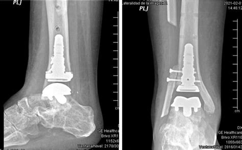 Retirada de artrodesis por prótesis de tobillo Los Mejores