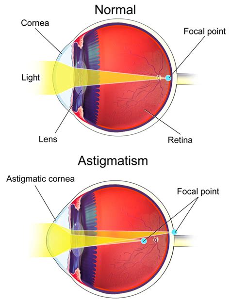 Astigmatism Central Florida Eye Center Pa