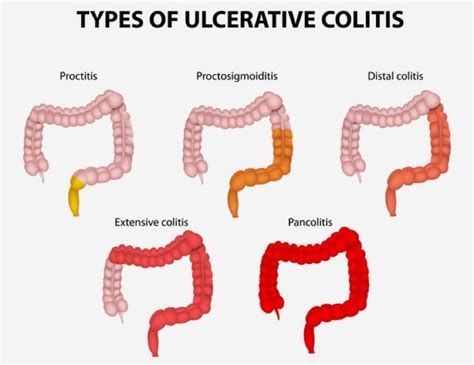 Can Ulcers Cause Blood In Your Stool Ulcertalk Hot Sex Picture