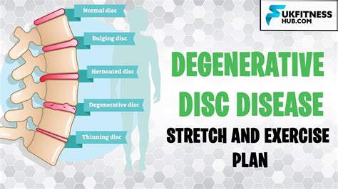 Ddd Degenerative Disc Disease Stretch And Exercise Plan Youtube