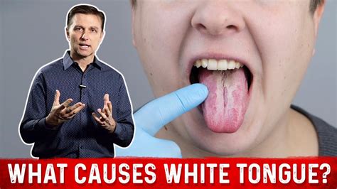 What Causes White Tongue Drberg On Oral Candidiasis