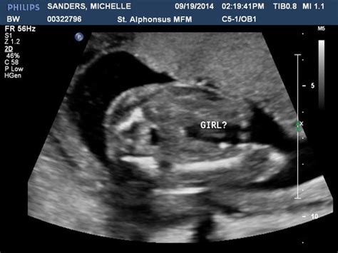 Girl Or Boy Ultrasound At 20 Weeks Along Due Feb 5th