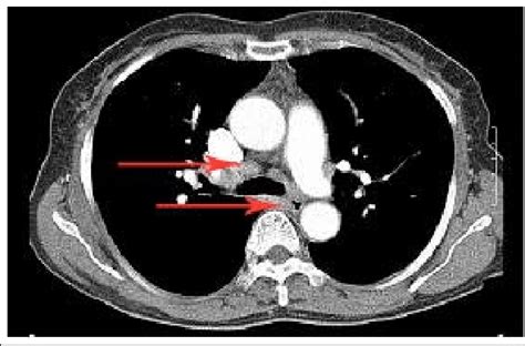 Chest X Ray Showing Bilateral Hilar Lymphadenopathy In A Patient With