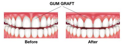 Gum Grafting Procedure Gum Surgery Birmingham Al Periodontist