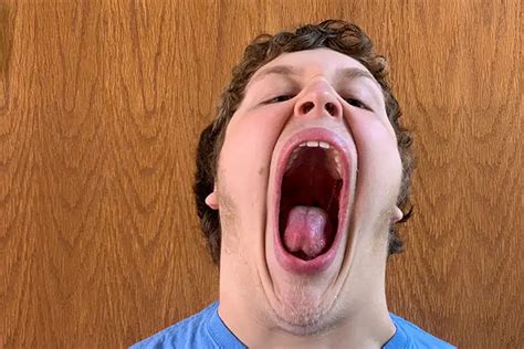 Teen From Pennsylvania Has The World’s Largest Mouth Gape Guinness World Records