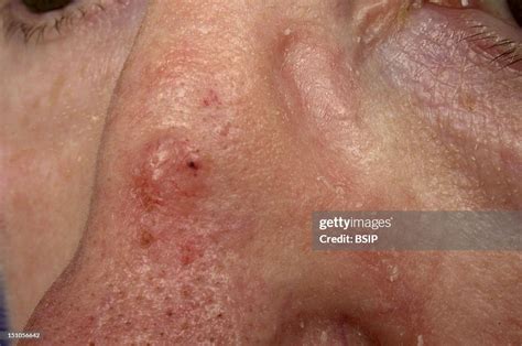 Infiltrating Basal Cell Carcinoma Of The Nasal Dorsum News Photo