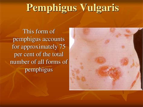 Bullous And Vesicular Dermatoses презентация онлайн