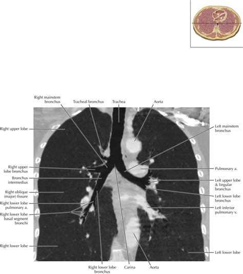Pulmonary Anatomy And Variants Radiology Key