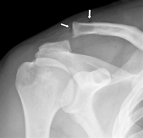 Ac Joint Fracture