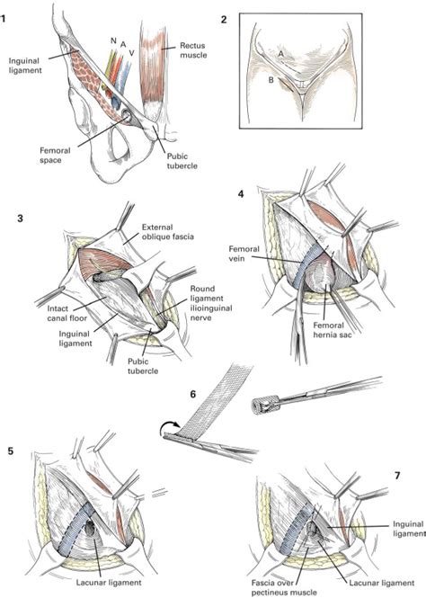 This is because the female pelvis is wider than the male pelvis. Femoral Hernia Repair Treatment : GetWellGo - India's Best Healthcare Services