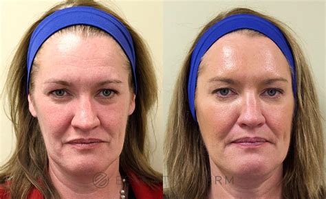 Botox Cosmetic Before And After Photo Gallery Natick Ma Essential