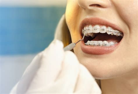 Braces Teeth Straightening For Bloomington Il