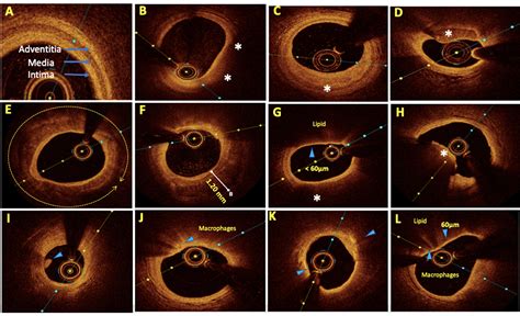 Frontiers Optical Coherence Tomography An Eye Into The Coronary Artery