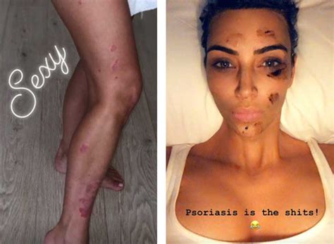 How Celebrities Treat Psoriasis Kim Kardashian Cara Delevingne And