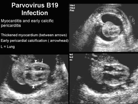 Ultrasound Of Parvovirus B19 Infection