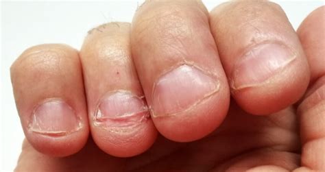 How To Stop Biting Nails In 9 Minutes 2022
