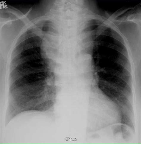 Thyroid Goiter On Chest X Ray X Rays Case Studies Ctisus Ct Scanning