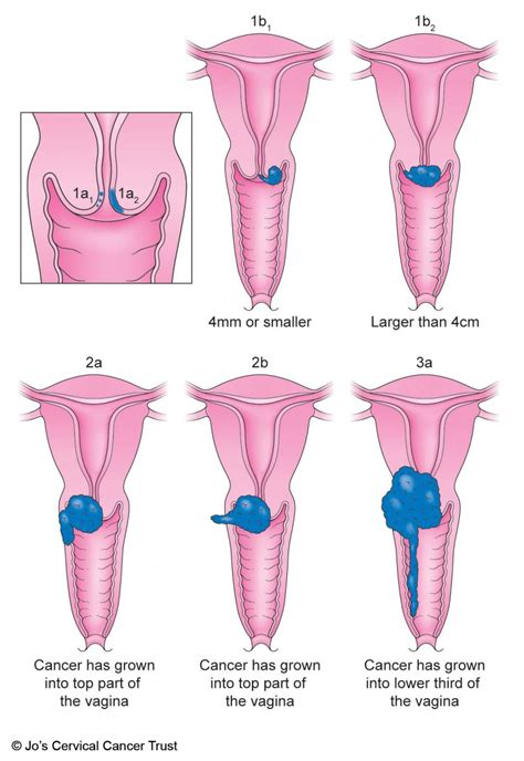 Signs Of Cervical Cancer Metastasis Uterine Endometrial Cancer