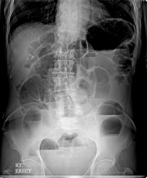 Gastrointestinal Perforation X Ray Wikidoc