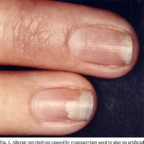 Figure 1 From Allergic Onycholysis Caused By Cyano Acrylate Used To Glue Artificial Nails