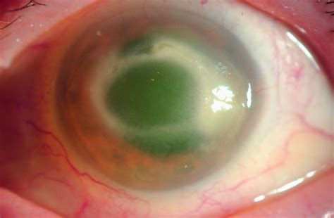 It depends on the type of contacts you buy. Eye-Eating Amoeba Causes Blindness in Contact Lens Wearers