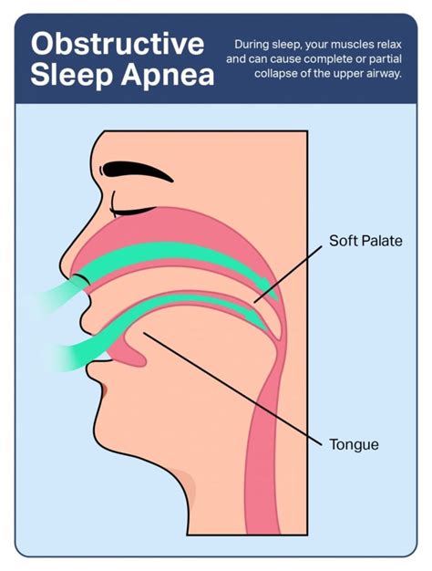 obstructive sleep apnea symptoms causes and treatments sleep foundation