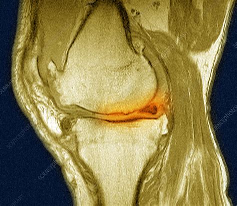 Knee Arthritis Mri Stock Image C027 1376 Science Photo Library