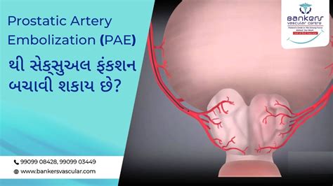 Prostatic Artery Embolization Can Save Sexual Function Compred To Turp Bankers Vascular Centre