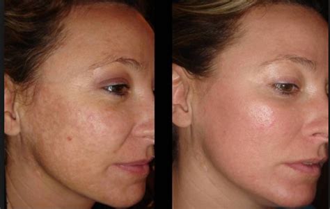 Post Inflammatory Hyperpigmentation Is A Skin Condition In Which The