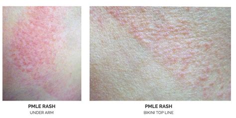 Pmle Treatment Sun Allergy Shirudo Cosmetics Inc
