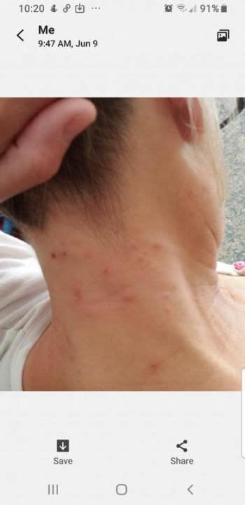 A Photo Of A Neck Rash Submitted By One Of Our Readers Rash On Neck