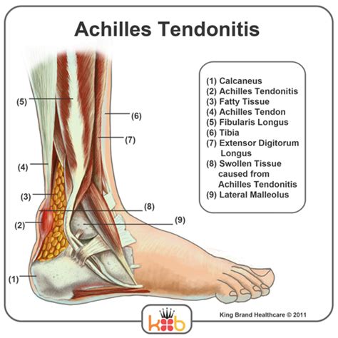 What are common knee tendons/ligament problems? King Brand Ankle Images