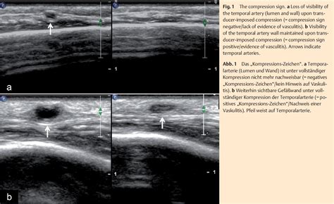Pdf Temporal Artery Compression Sign A Novel Ultrasound Finding For