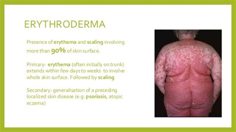 Case Presentation In Dermatology Erythrodermic Psoriasis
