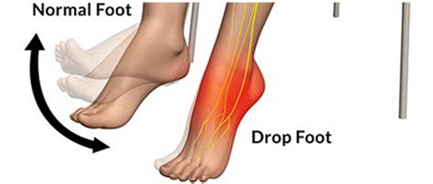 Foot Drop Causes Symptoms Homeopathic Treatment