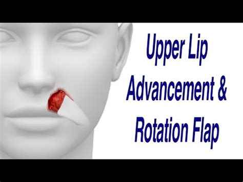 Upper Lip Cancer Excision With Advancement Rotation Flap