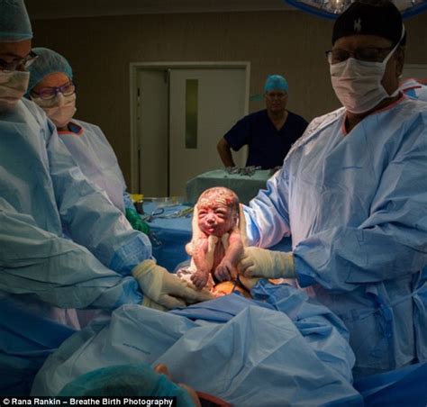 Incredible Images Show A Mother Delivering Her Own Baby Via Caesarean