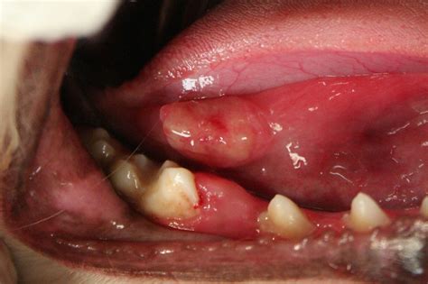 Oral Ulcer Flickr Photo Sharing