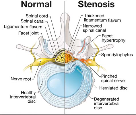 Lumbar Spinal Stenosis Oxford Spine And Neuro