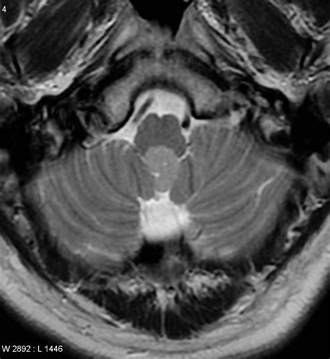 Subependymoma Fourth Ventricle Radiology Case