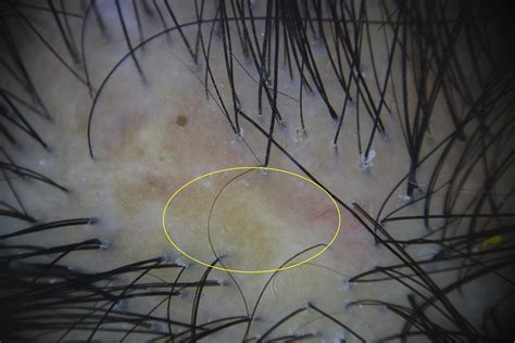 Regarding Trichoscopy Of Dissecting Cellulitis Of The Scalp Journal