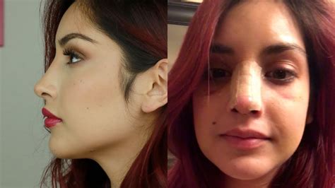 Dealing With Post Surgery Blues After Rhinoplasty 10 Months Post Op