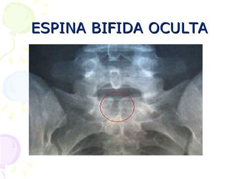 Espina Bifida Oculta Diagnostico Pdf